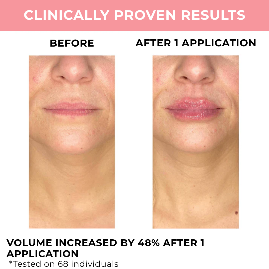 Lumpy Lip Boost™ | Lip Volume Treatment